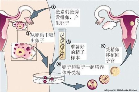 孕妈试管咨询服务代生儿子